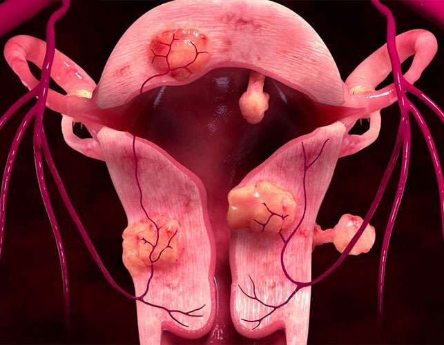 Uterine Fibroid Embolization From Ng Vascular And Vein Center